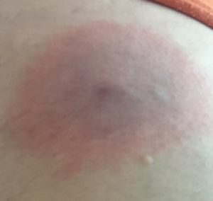 This was my Bulls-Eye Rash. It showed up four days after I started getting sick and a day after I started treatment.